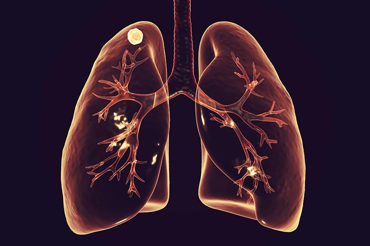 Akciğer Nodülleri Tehlikeli Midir ve Nasıl Tedavi Edilir?