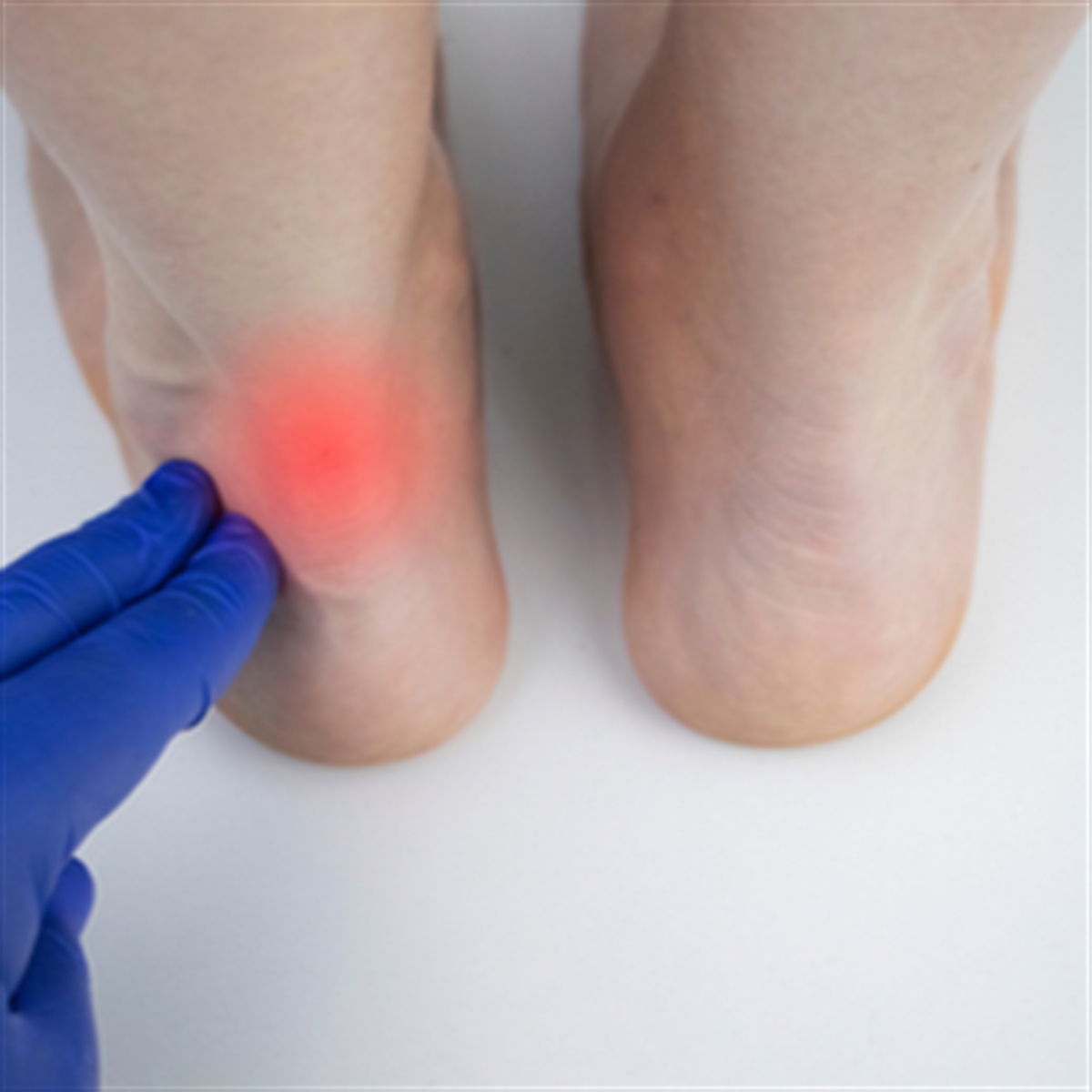 asil tendonu nedir asil tendonu kopmasi ve tedavi yontemleri medicana saglik grubu
