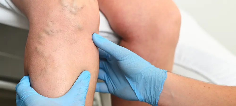 Bacak damar tıkanıklığı nedir? Bacakta damar tıkanıklığı nasıl açılır? Bacak damar tıkanıklığı nedir? Bacakta damar tıkanıklığı nasıl açılır?