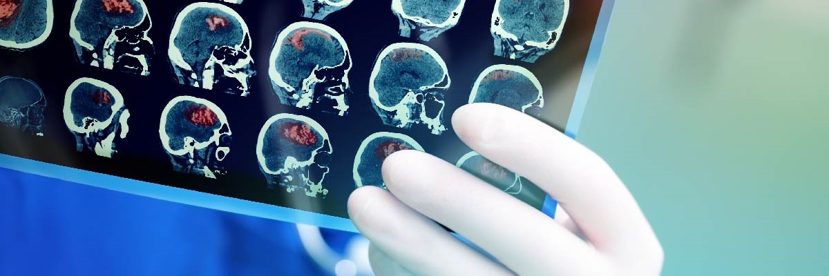 Beyin Kanseri Nedir ve Tedavisi Nasıldır?