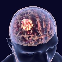 beyin tumoru nedir medicana saglik grubu