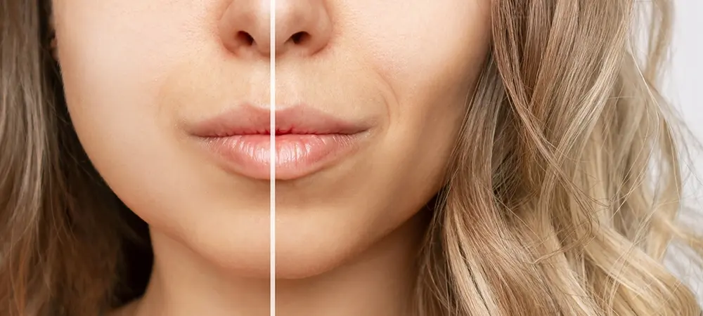 Bişektomi nedir? Bişektomi nasıl yapılır?