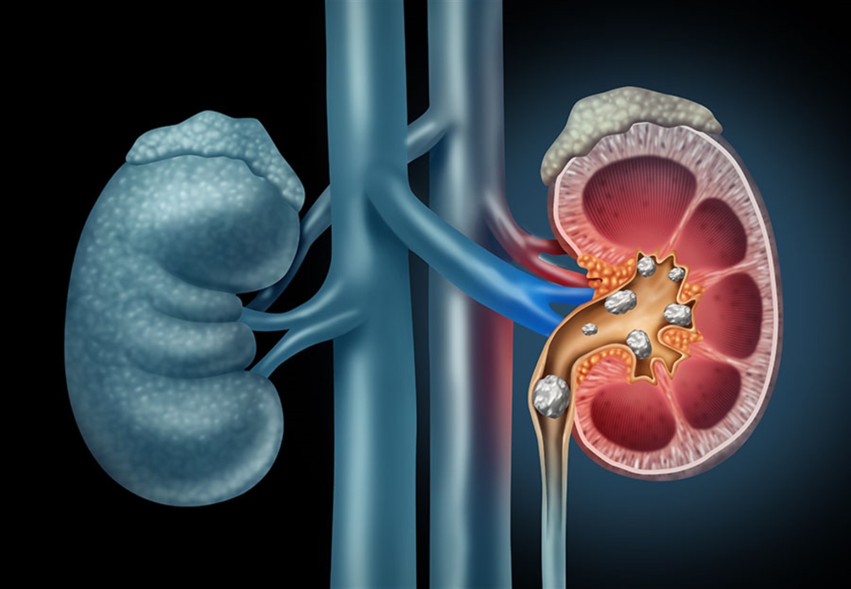 Böbrek Taşı Neden Oluşur ve Nasıl Düşer? | Medicana