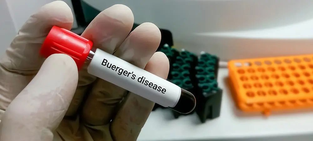 Buerger hastalığı nedir? Buerger hastalığı neden olur? Buerger hastalığı nedir? Buerger hastalığı neden olur?