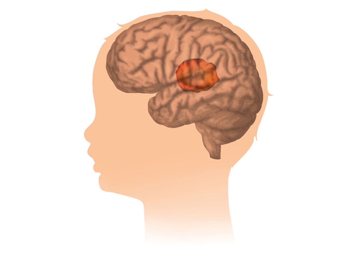Çocukluk Çağı Beyin Tümörleri Hakkında Bilgiler