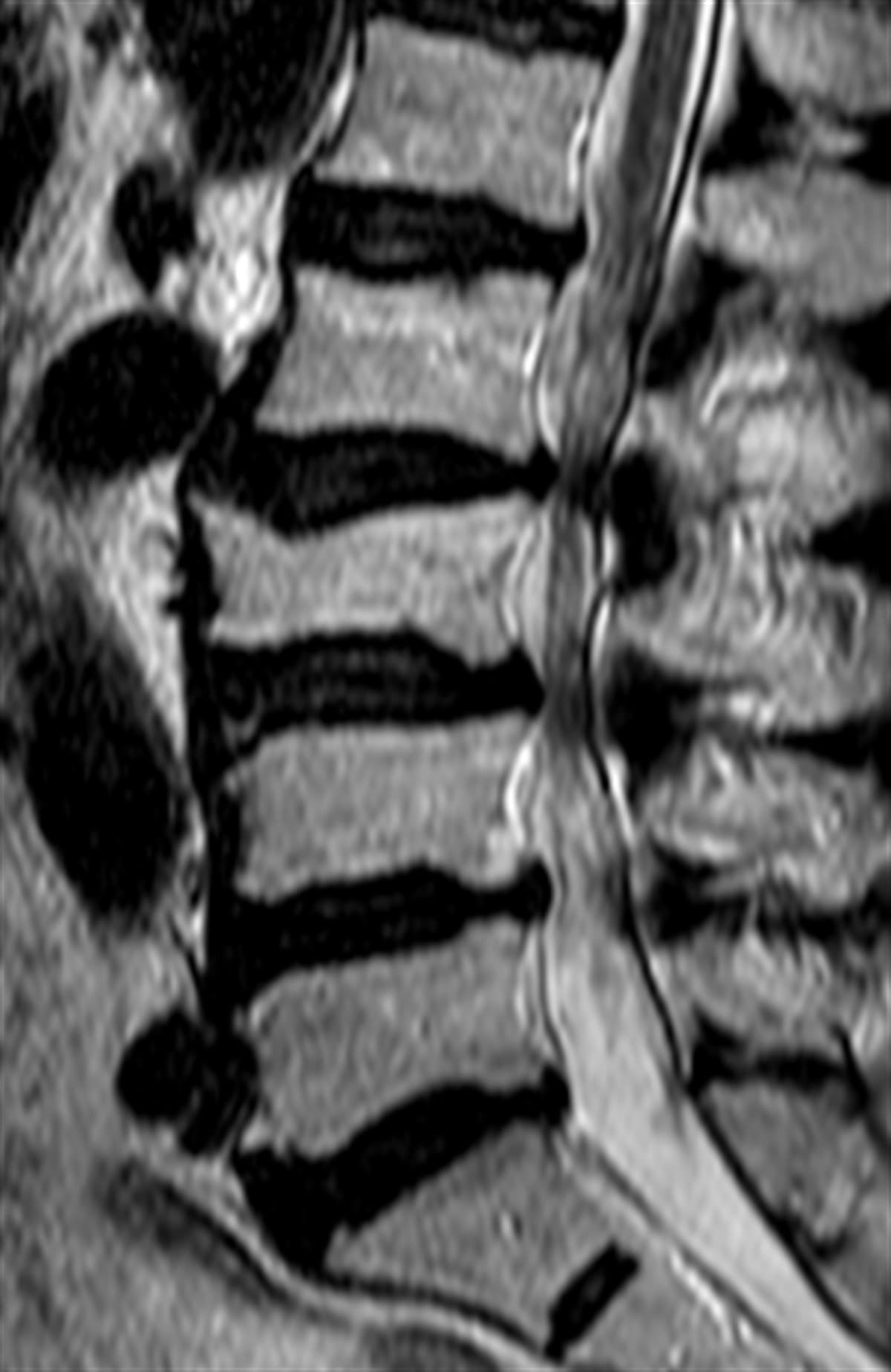 Kanal Darlığı (Spinal Stenoz)