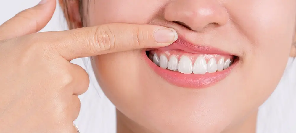 Diş eti çekilmesi neden olur? Diş eti çekilmesine ne iyi gelir? Diş eti çekilmesi neden olur? Diş eti çekilmesine ne iyi gelir?