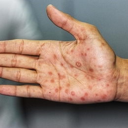 Frengi Sifiliz Hastaligi Nedir Ve Belirtileri Nelerdir Medicana