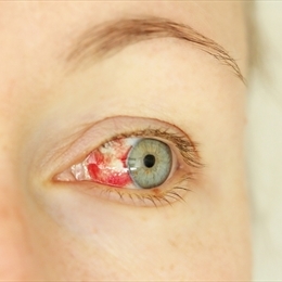 Göz Kanlanması Neden Olur ve Nasıl Geçer? Tedavisi Hakkında Detaylar