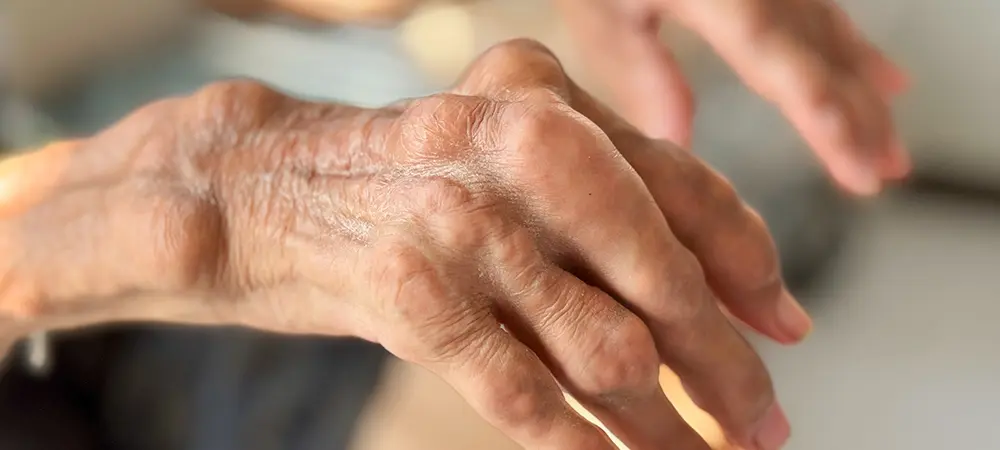 Gut hastalığı nedir? Gut hastalığı olanlar nasıl beslenmeli? Gut hastalığı nedir? Gut hastalığı olanlar nasıl beslenmeli?