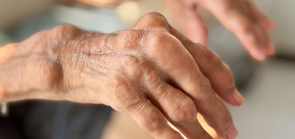 Gut hastalığı nedir? Gut hastalığı olanlar nasıl beslenmeli?