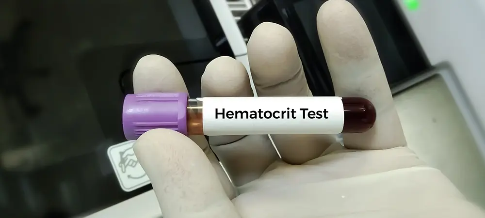 HCT (hematokrit) ne demek? HCT yüksekliği neden olur? HCT (hematokrit) ne demek? HCT yüksekliği neden olur?