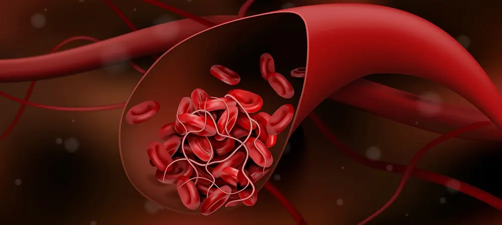 Kan pıhtılaşması (tromboz) nedir? Kan pıhtılaşmasına ne iyi gelir? Kan pıhtılaşması (tromboz) nedir? Kan pıhtılaşmasına ne iyi gelir?