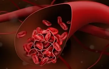 Kan pıhtılaşması (tromboz) nedir? Kandaki pıhtılaşmaya ne iyi gelir?