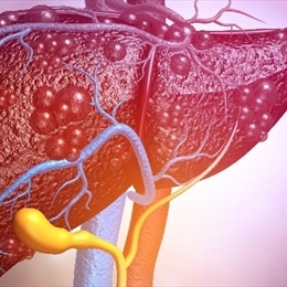 Karaciğer Kanseri Nedir?