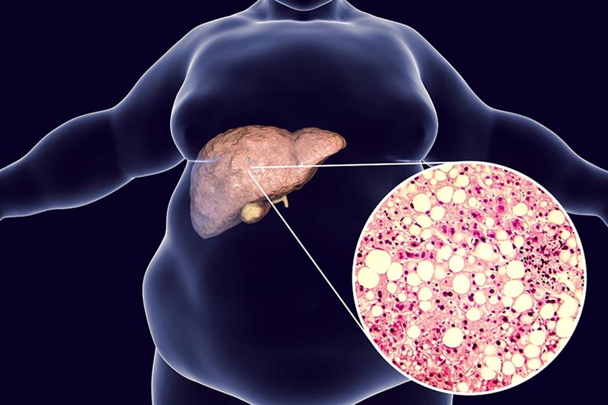 Karaciğer Yağlanması Neden Olur? Belirtileri & Tedavisi