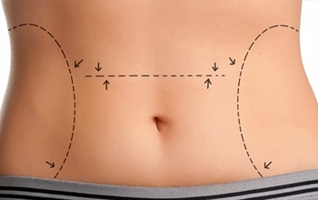 “Liposuction ile temel amaç kilo kaybı değil”