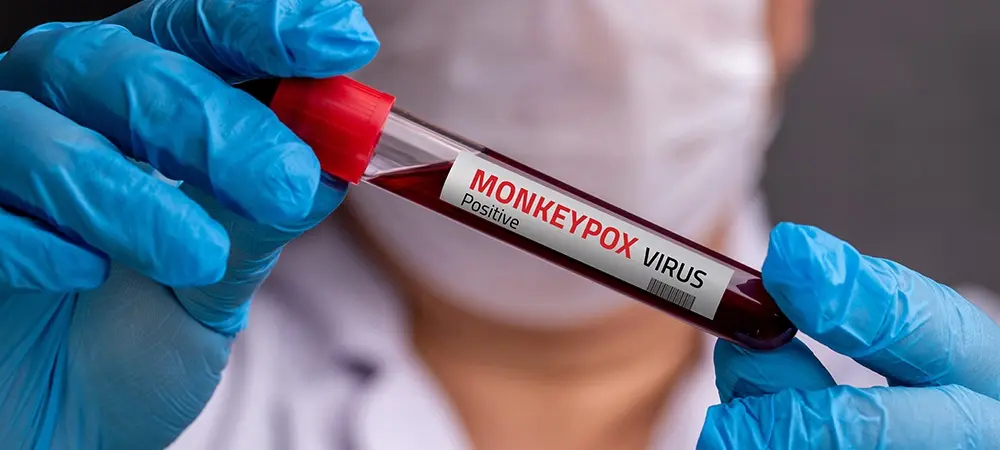 Maymun çiçeği virüsü (monkeypox) nedir? Maymun çiçeğinin belirtileri nelerdir? Maymun çiçeği virüsü (monkeypox) nedir? Maymun çiçeğinin belirtileri nelerdir?