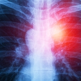 Mezotelyoma (Akciğer Zarı Kanseri) Nedir? Belirtileri ve Tedavi Yöntemleri