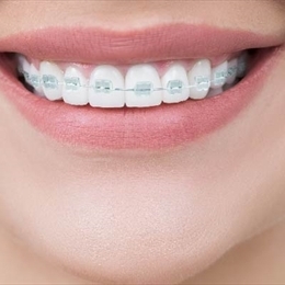 Şeffaf Diş Teli Nedir?