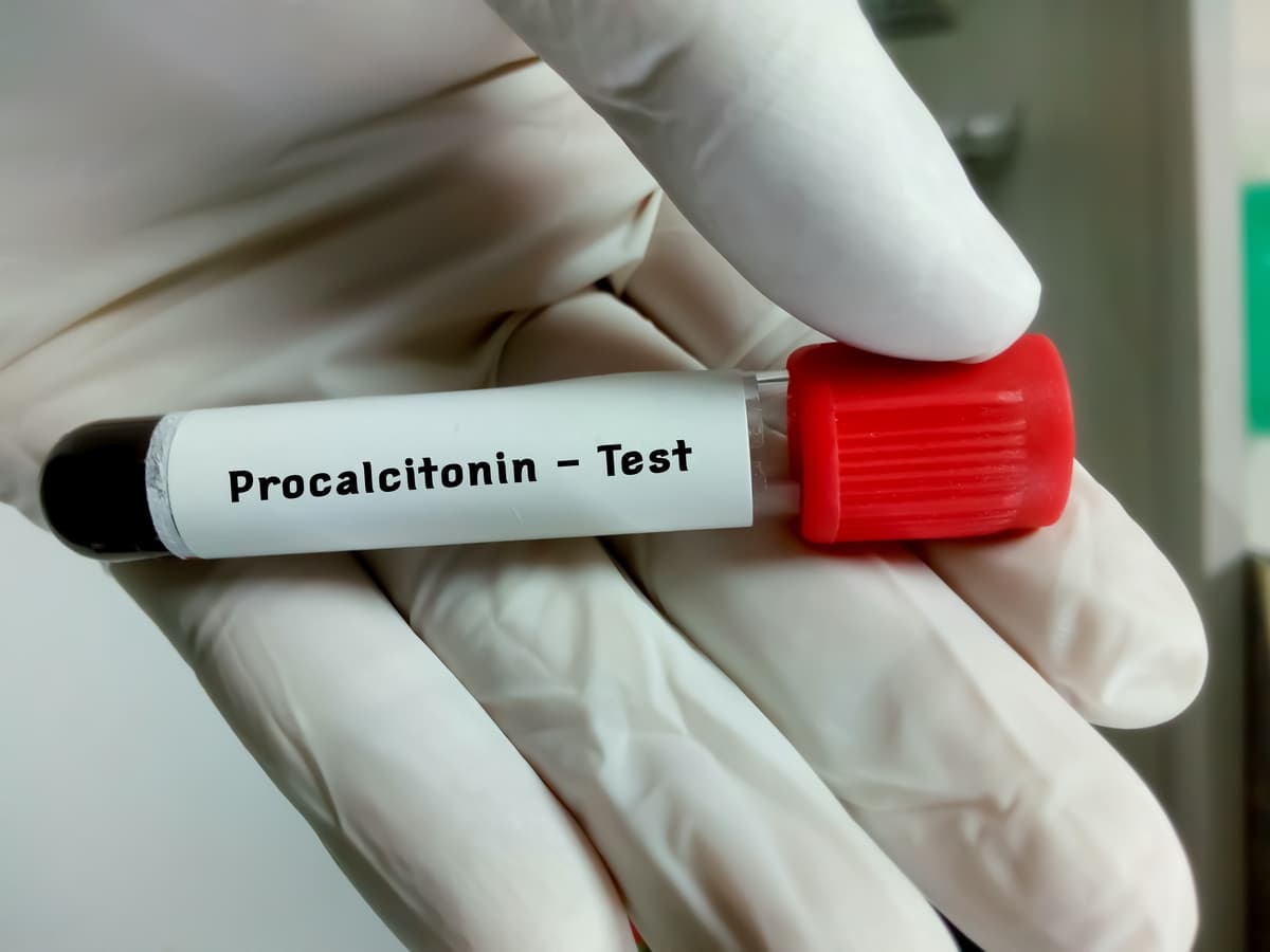 Prokalsitonin (PCT)