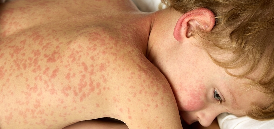 Rubella (Kızamıkçık) nedir? Rubellanın belirtileri neler?