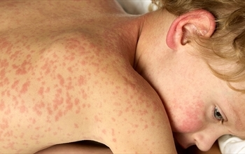 Rubella (Kızamıkçık) nedir? Rubellanın belirtileri neler?