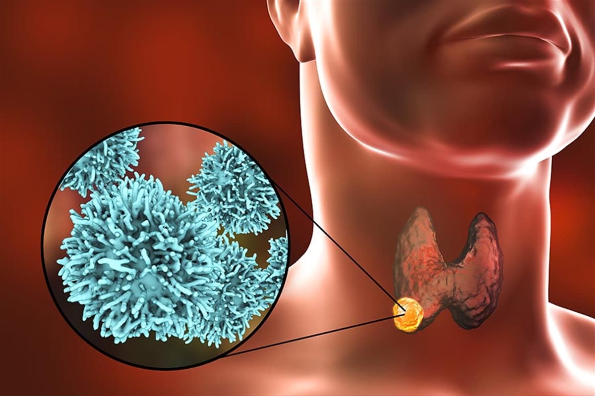 Tiroid Kanseri-Belirtileri, Nedenleri, Tanısı ve Tedavisi