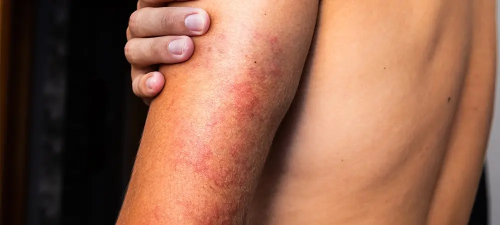 Vaskülit nedir? Vaskülitin (damar iltihabı) belirtileri nelerdir? Vaskülit nedir? Vaskülitin (damar iltihabı) belirtileri nelerdir?