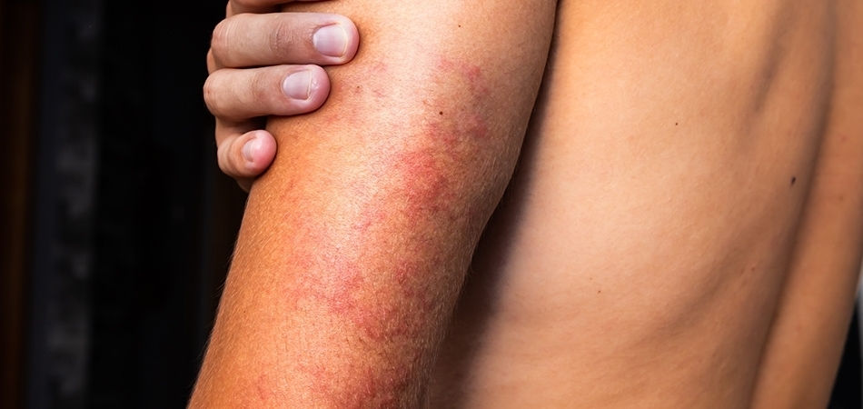 Vaskülit nedir? Vaskülitin (damar iltihabı) belirtileri nelerdir?